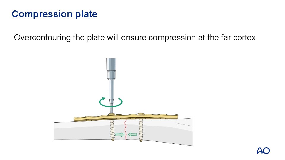 Compression plate Overcontouring the plate will ensure compression at the far cortex 