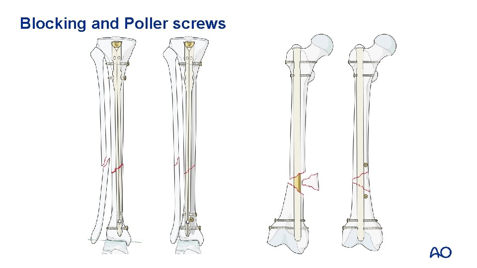 Blocking and Poller screws 