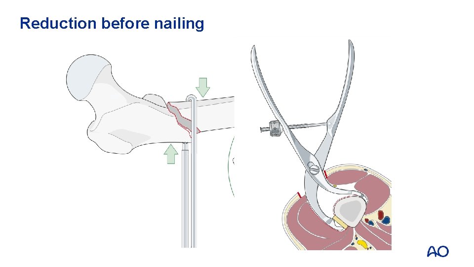 Reduction before nailing 