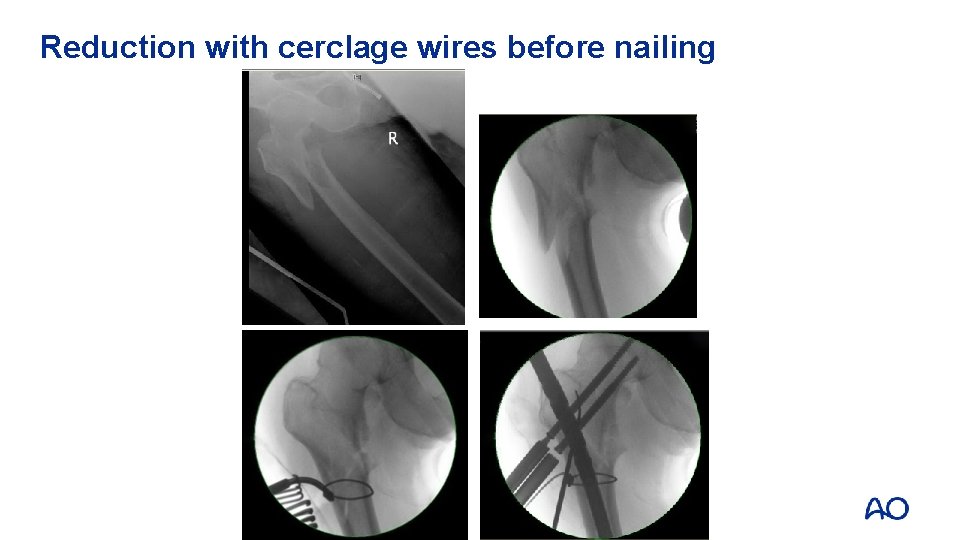 Reduction with cerclage wires before nailing 