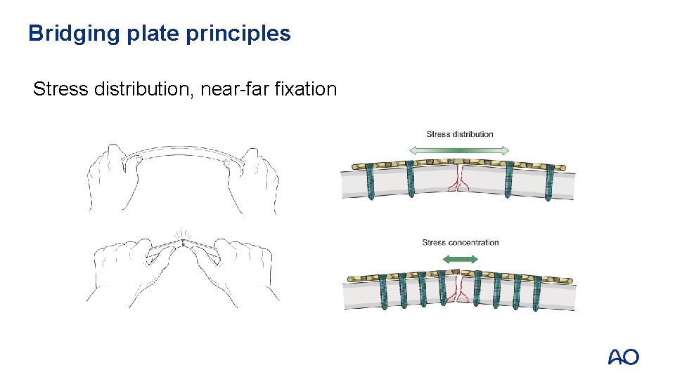 Bridging plate principles Stress distribution, near-far fixation 