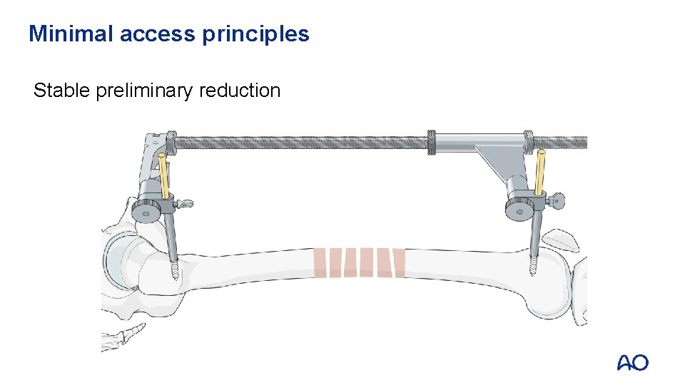 Minimal access principles Stable preliminary reduction 