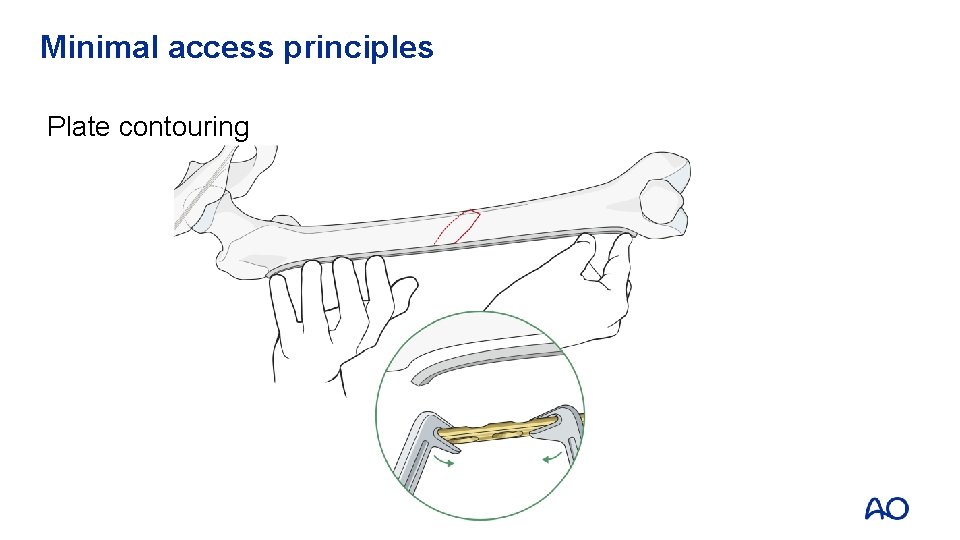 Minimal access principles Plate contouring 