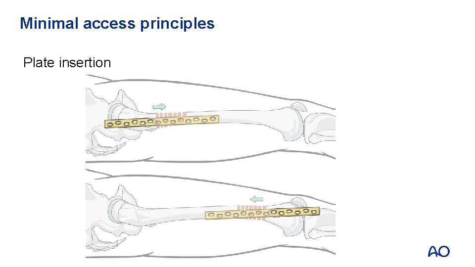 Minimal access principles Plate insertion 
