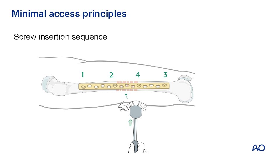 Minimal access principles Screw insertion sequence 