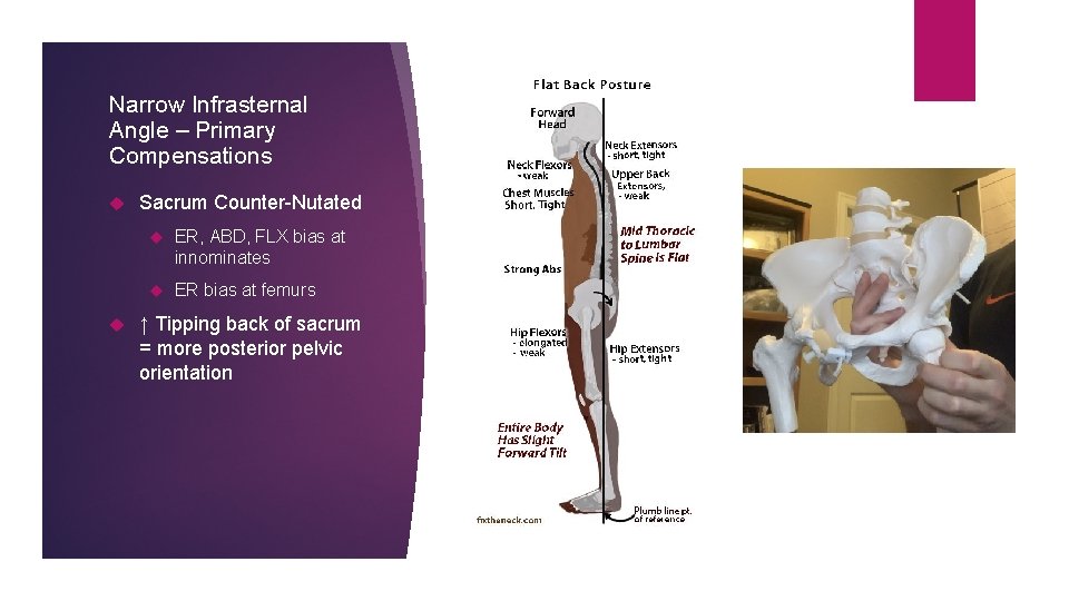 Narrow Infrasternal Angle – Primary Compensations Sacrum Counter-Nutated ER, ABD, FLX bias at innominates