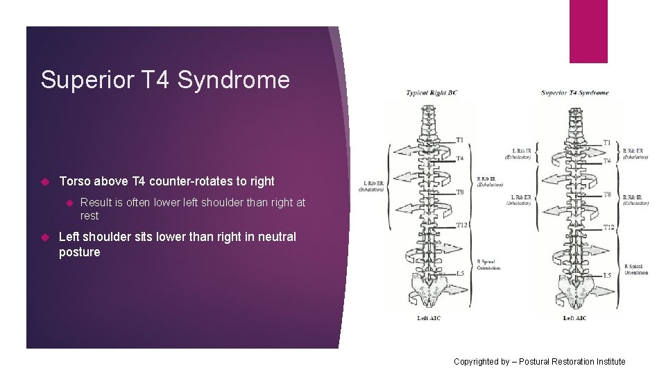 Superior T 4 Syndrome Torso above T 4 counter-rotates to right Result is often