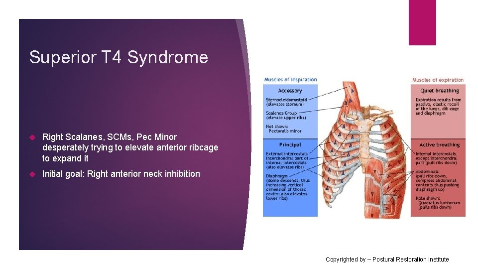 Superior T 4 Syndrome Right Scalanes, SCMs, Pec Minor desperately trying to elevate anterior
