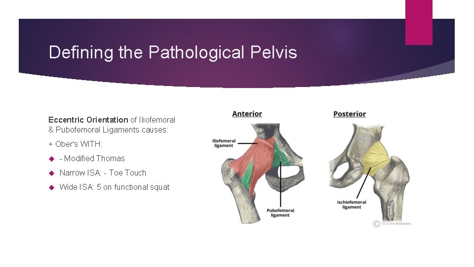 Defining the Pathological Pelvis Eccentric Orientation of Iliofemoral & Pubofemoral Ligaments causes: + Ober's