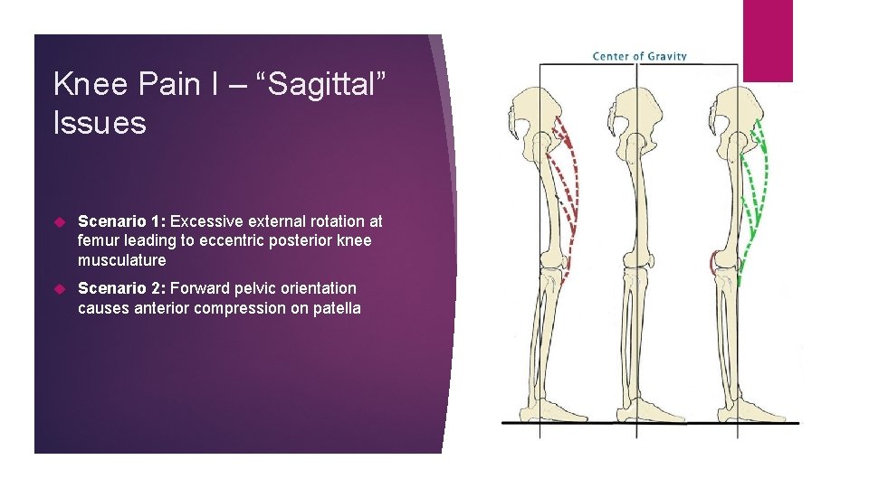 Knee Pain I – “Sagittal” Issues Scenario 1: Excessive external rotation at femur leading