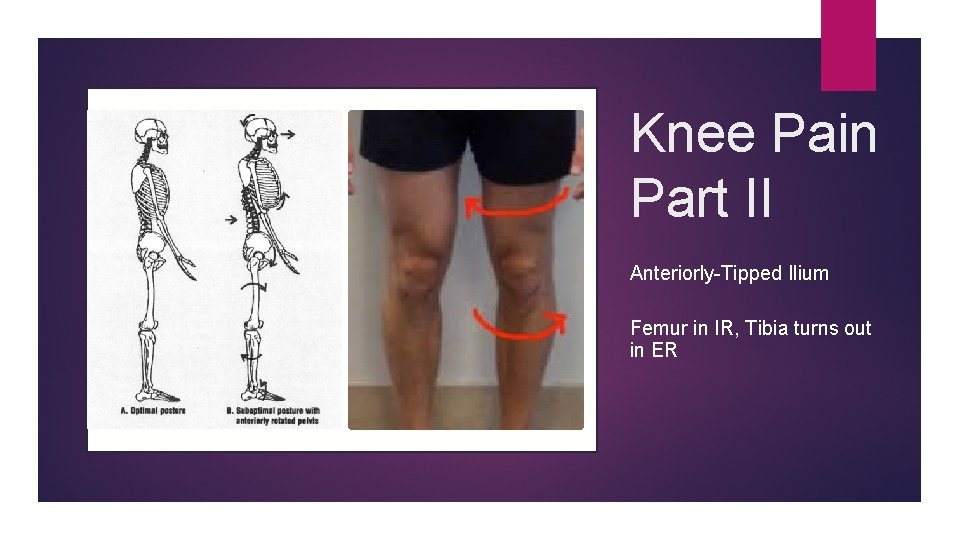 Knee Pain Part II Anteriorly-Tipped Ilium Femur in IR, Tibia turns out in ER