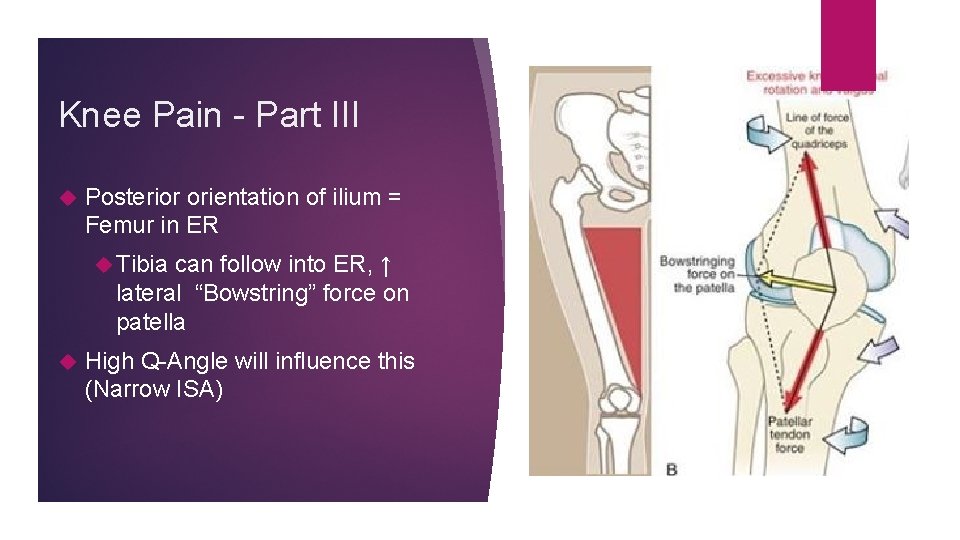 Knee Pain - Part III Posterior orientation of ilium = Femur in ER Tibia