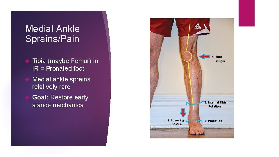 Medial Ankle Sprains/Pain Tibia (maybe Femur) in IR = Pronated foot Medial ankle sprains