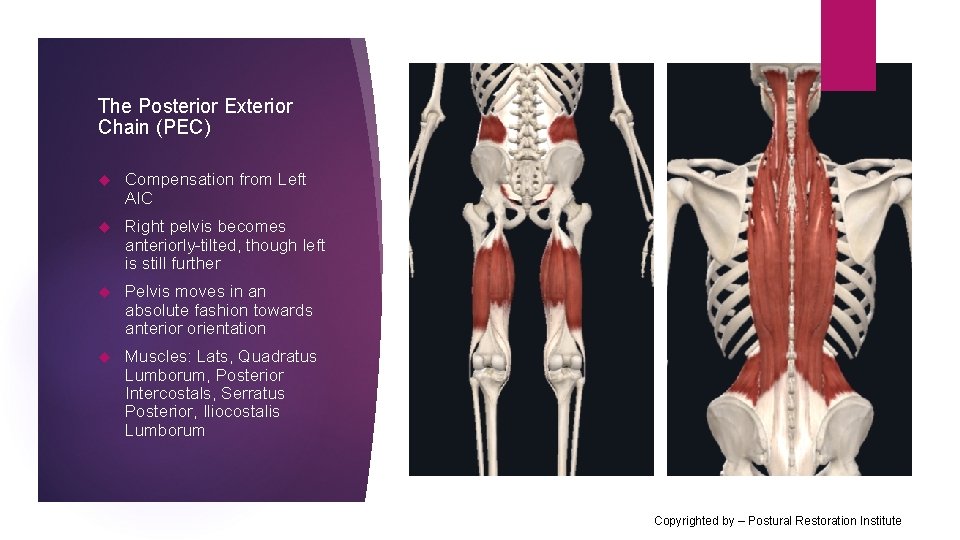 The Posterior Exterior Chain (PEC) Compensation from Left AIC Right pelvis becomes anteriorly-tilted, though