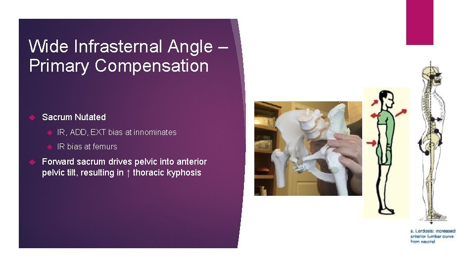 Wide Infrasternal Angle – Primary Compensation Sacrum Nutated IR, ADD, EXT bias at innominates