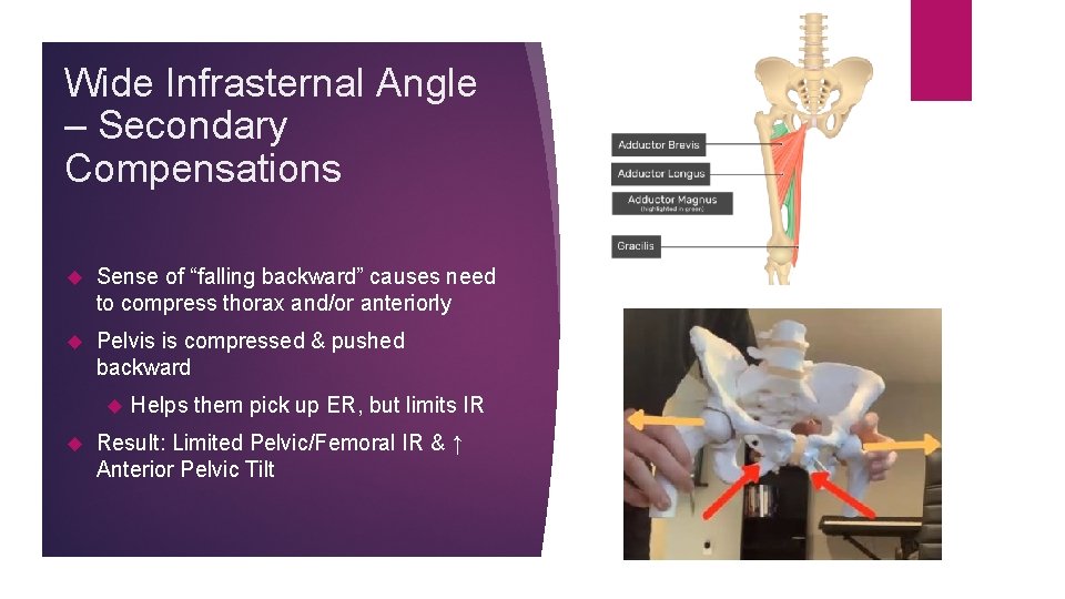 Wide Infrasternal Angle – Secondary Compensations Sense of “falling backward” causes need to compress