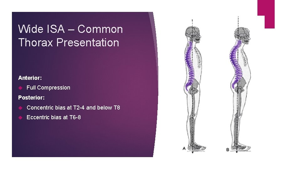 Wide ISA – Common Thorax Presentation Anterior: Full Compression Posterior: Concentric bias at T