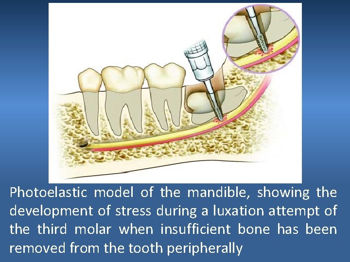 Photoelastic model of the mandible, showing the development of stress during a luxation attempt