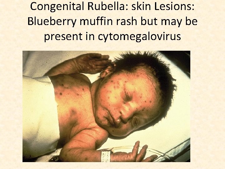 Congenital Rubella: skin Lesions: Blueberry muffin rash but may be present in cytomegalovirus 