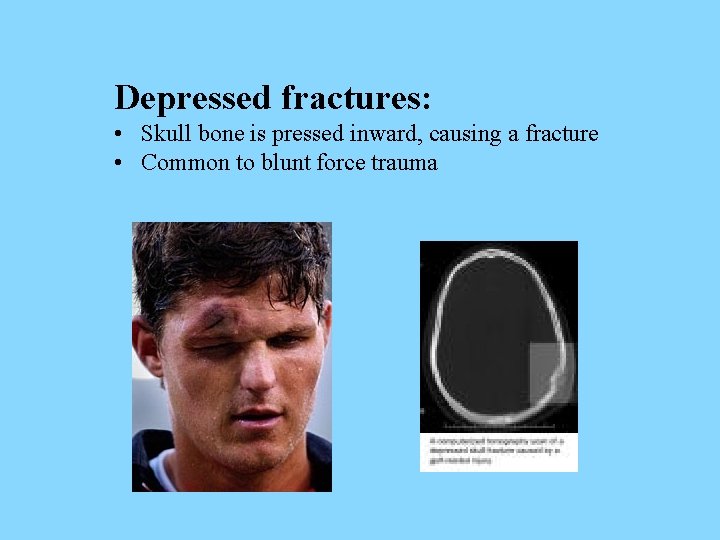 Depressed fractures: • Skull bone is pressed inward, causing a fracture • Common to
