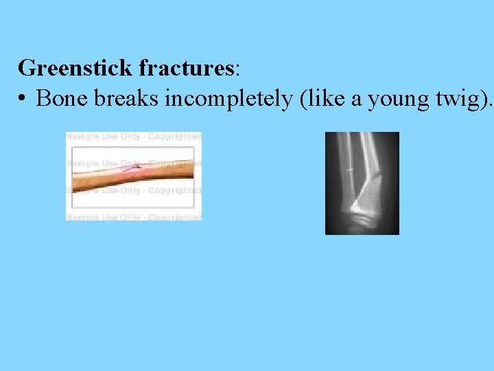 Greenstick fractures: • Bone breaks incompletely (like a young twig). 