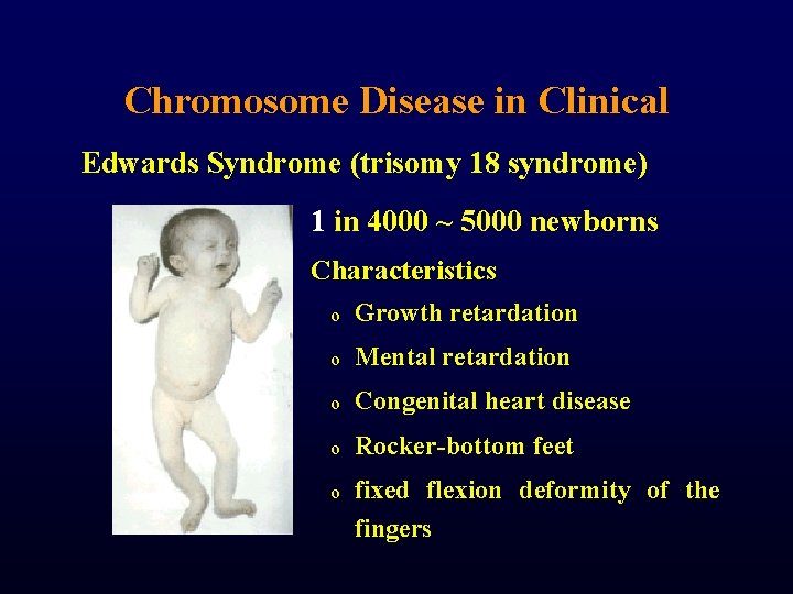 Chromosome Disease in Clinical Edwards Syndrome (trisomy 18 syndrome) 1 in 4000 ~ 5000