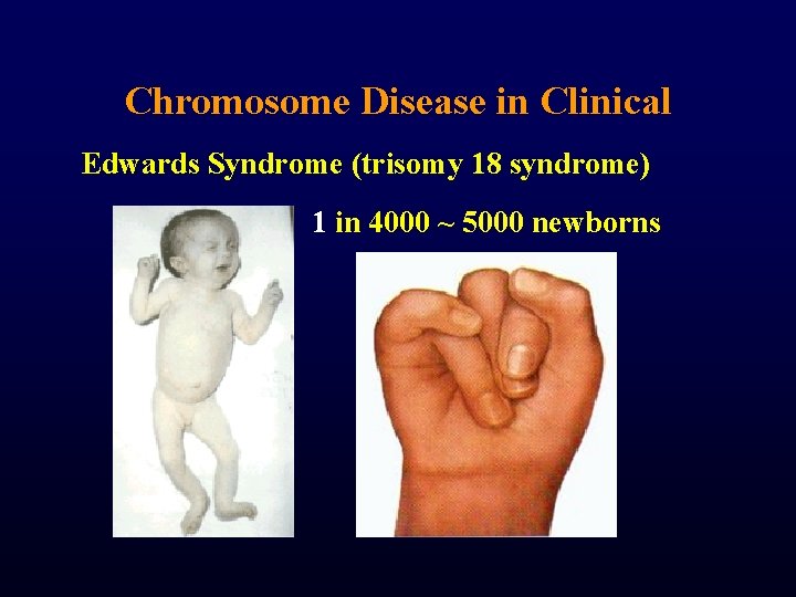 Chromosome Disease in Clinical Edwards Syndrome (trisomy 18 syndrome) 1 in 4000 ~ 5000