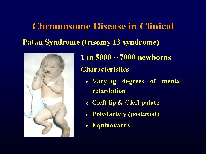Chromosome Disease in Clinical Patau Syndrome (trisomy 13 syndrome) 1 in 5000 ~ 7000