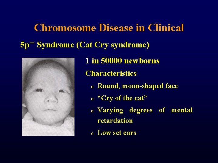 Chromosome Disease in Clinical 5 p－ Syndrome (Cat Cry syndrome) 1 in 50000 newborns
