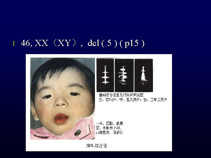l 46, XX（XY）, del ( 5 ) ( p 15 ) 