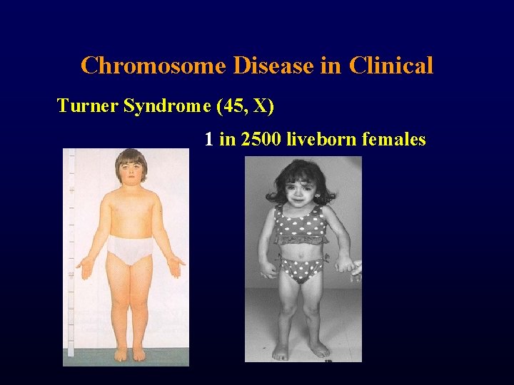 Chromosome Disease in Clinical Turner Syndrome (45, X) 1 in 2500 liveborn females 