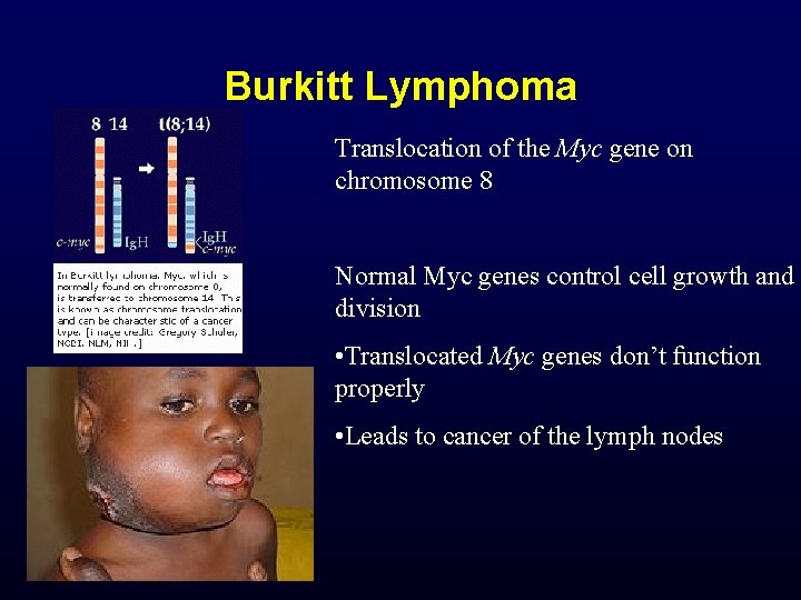 Burkitt Lymphoma Translocation of the Myc gene on chromosome 8 Normal Myc genes control