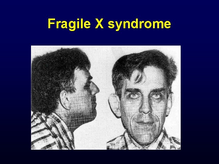 Fragile X syndrome 