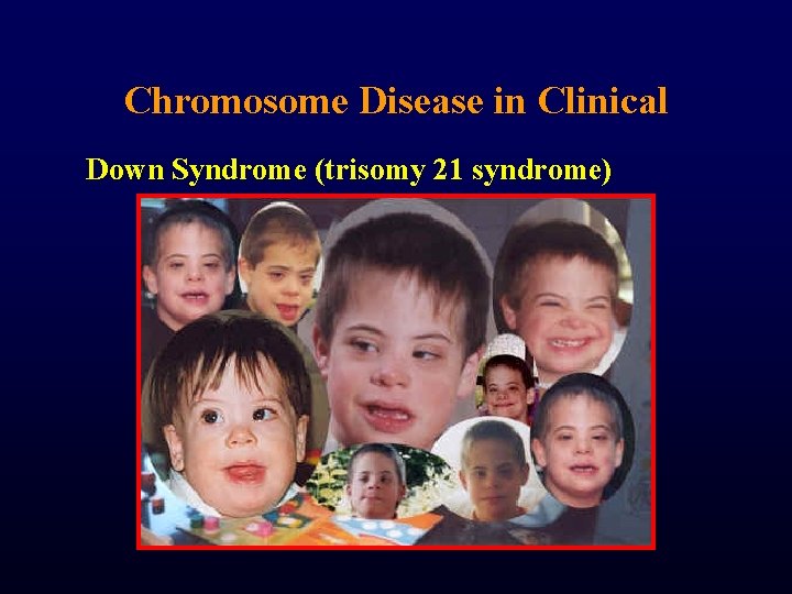 Chromosome Disease in Clinical Down Syndrome (trisomy 21 syndrome) 