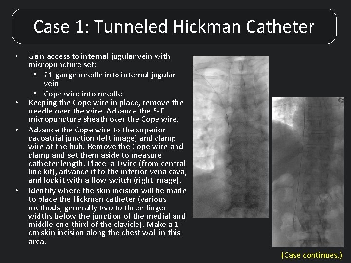 Case 1: Tunneled Hickman Catheter • • Gain access to internal jugular vein with