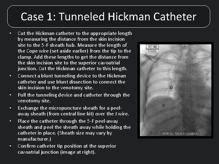 Case 1: Tunneled Hickman Catheter • • • Cut the Hickman catheter to the