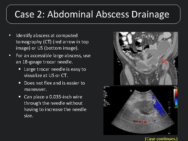 Case 2: Abdominal Abscess Drainage • Identify abscess at computed tomography (CT) (red arrow