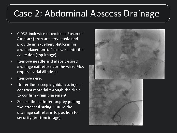 Case 2: Abdominal Abscess Drainage • • • 0. 035 -inch wire of choice