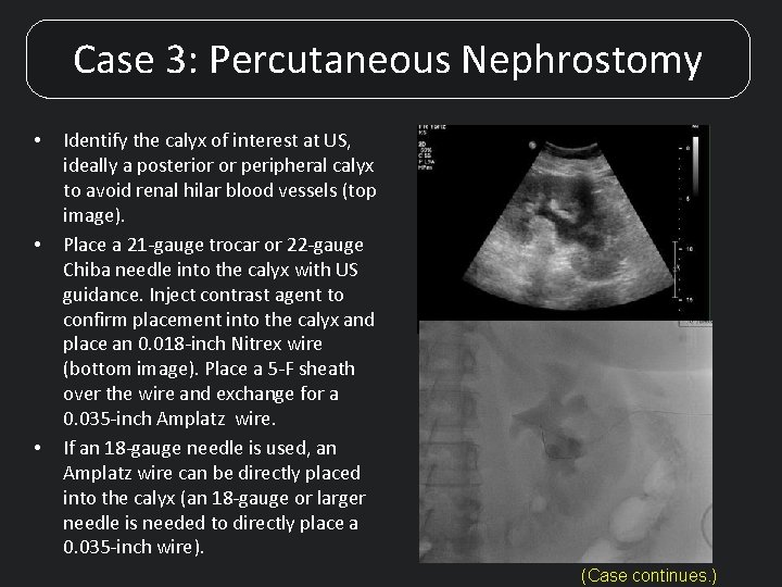 Case 3: Percutaneous Nephrostomy • • • Identify the calyx of interest at US,