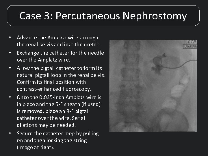 Case 3: Percutaneous Nephrostomy • Advance the Amplatz wire through the renal pelvis and