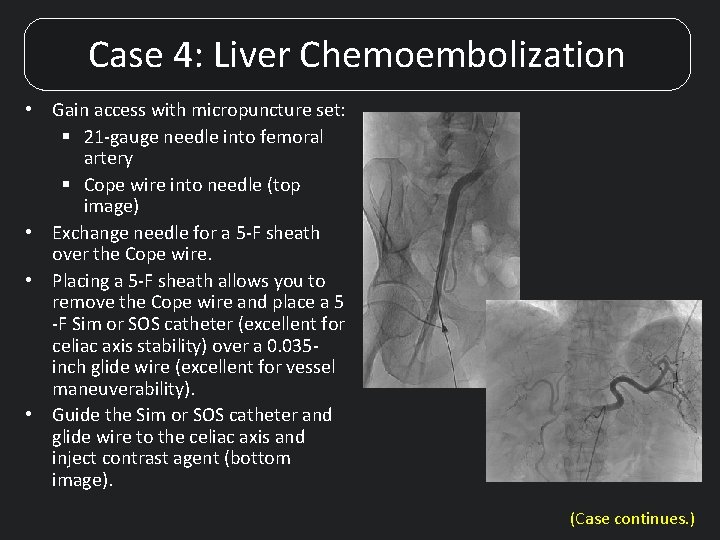 Case 4: Liver Chemoembolization • Gain access with micropuncture set: § 21 -gauge needle