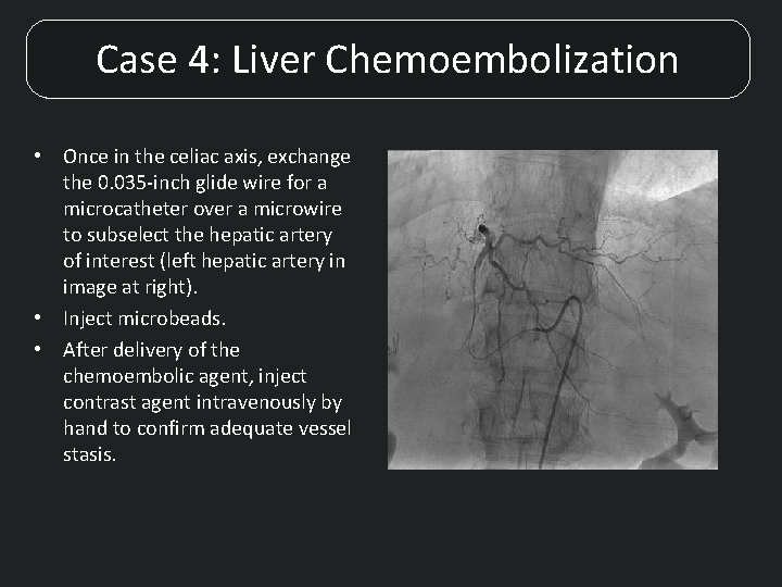 Case 4: Liver Chemoembolization • Once in the celiac axis, exchange the 0. 035