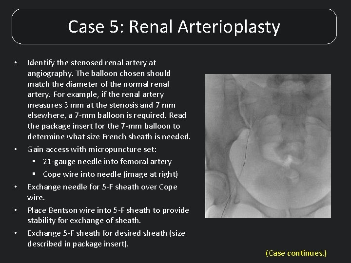 Case 5: Renal Arterioplasty • • • Identify the stenosed renal artery at angiography.