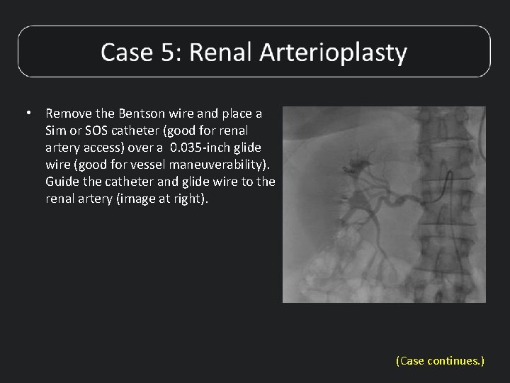  • Remove the Bentson wire and place a Sim or SOS catheter (good