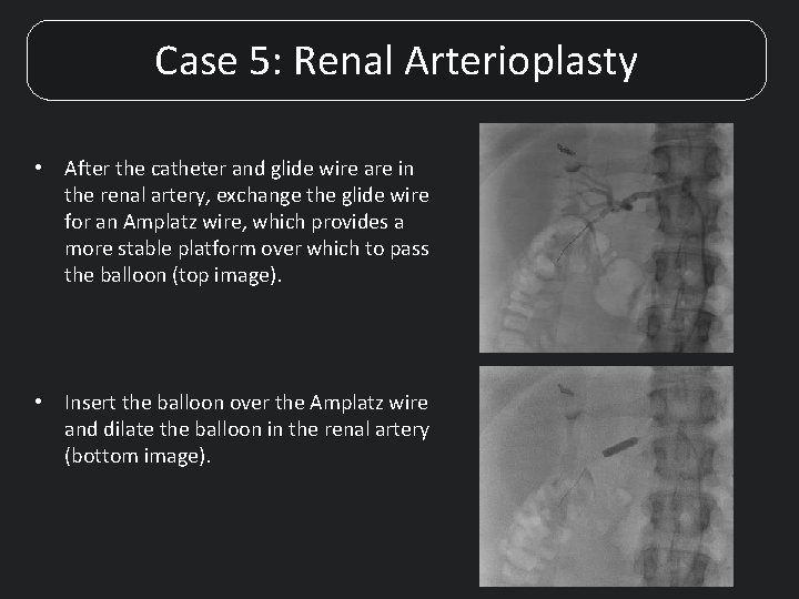 Case 5: Renal Arterioplasty • After the catheter and glide wire are in the