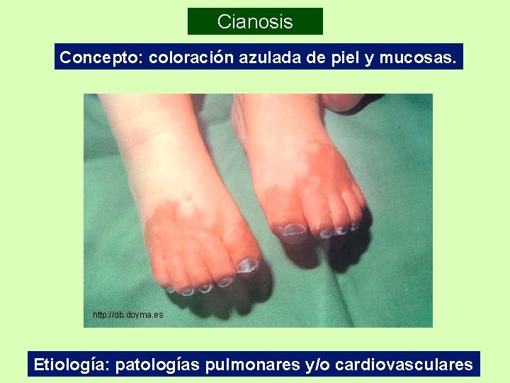 Cianosis Concepto: coloración azulada de piel y mucosas. http: //db. doyma. es Etiología: patologías Cianosis Concepto: coloración azulada de piel y mucosas. http: //db. doyma. es Etiología: patologías