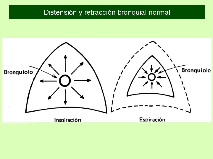 Distensión y retracción bronquial normal Modif. de Bevilacqua F. id. Distensión y retracción bronquial normal Modif. de Bevilacqua F. id.
