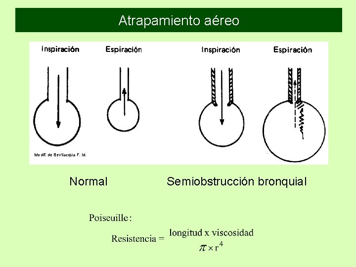 Atrapamiento aéreo Modif. de Bevilacqua F. id. Normal Semiobstrucción bronquial Atrapamiento aéreo Modif. de Bevilacqua F. id. Normal Semiobstrucción bronquial