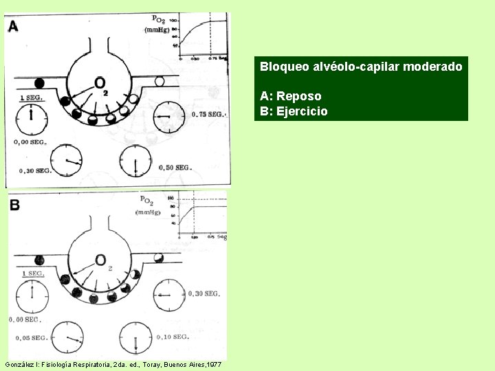 Bloqueo alvéolo-capilar moderado A: Reposo B: Ejercicio González I: Fisiología Respiratoria, 2 da. ed. Bloqueo alvéolo-capilar moderado A: Reposo B: Ejercicio González I: Fisiología Respiratoria, 2 da. ed.