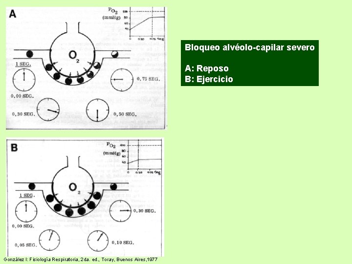Bloqueo alvéolo-capilar severo A: Reposo B: Ejercicio González I: Fisiología Respiratoria, 2 da. ed. Bloqueo alvéolo-capilar severo A: Reposo B: Ejercicio González I: Fisiología Respiratoria, 2 da. ed.